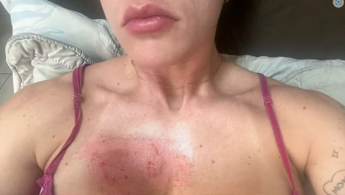 Mulher atingida por fogos de artifício dentro de apartamento no réveillon em SC mostra melhora dos ferimentos