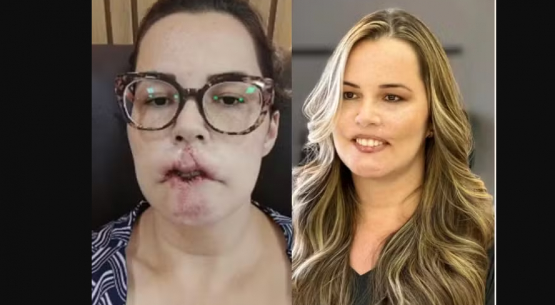 Em SC: Influencer que perdeu lábio por uso de PMMA mostra rosto após cirurgias: 'Já comprei um batom vermelho'