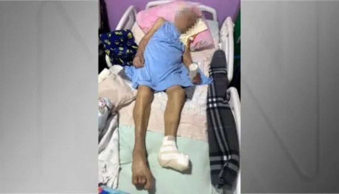 Idosa de 103 anos tem pé amputado por enfermeira sem anestesia no DF