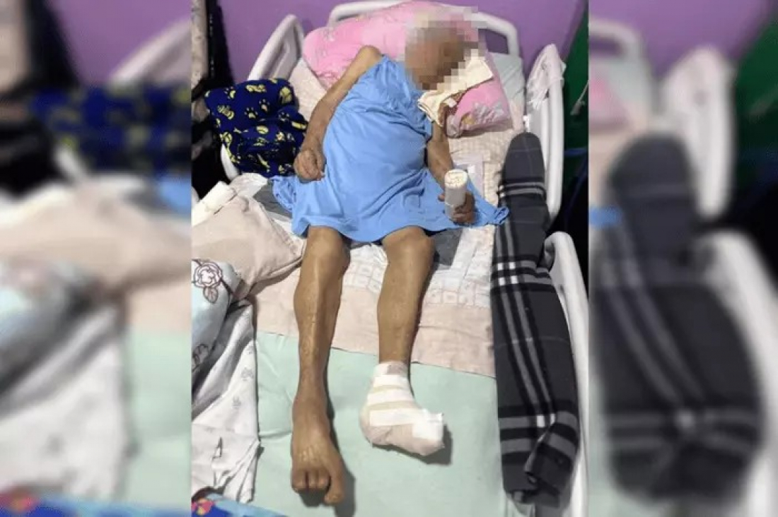 Polícia descarta crime em caso de idosa de 103 anos com pé amputado