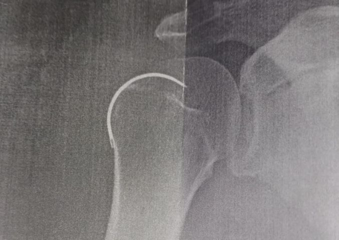 Médico esquece agulha em paciente após cirurgia em Armazém; homem ficou 5 meses com objeto no ombro