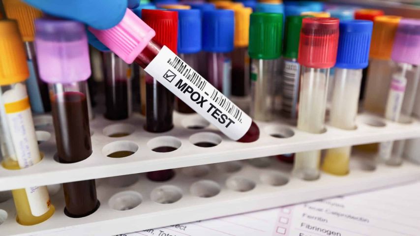 São Paulo confirma 1º caso de nova cepa de Mpox no Brasil