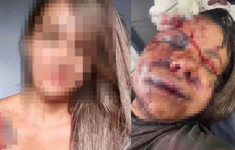 No país: mulher espancada com 60 socos por namorado teve rosto desfigurado