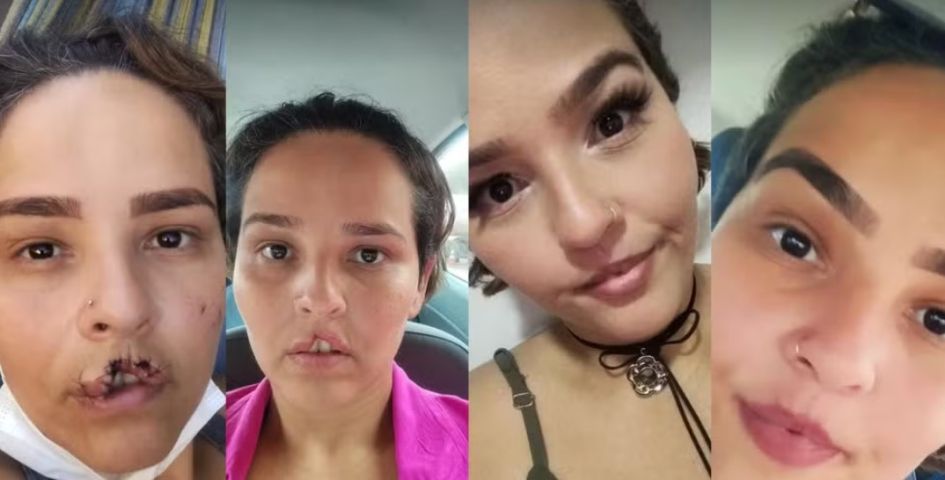 Em SC: Mulher que teve lábio arrancado por chow-chow comemora 2ª cirurgia reparadora