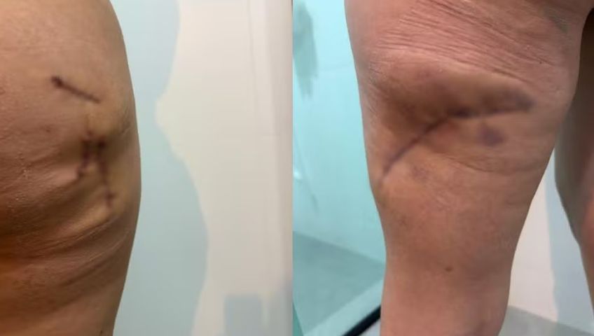 Modelo denuncia necrose após procedimento e clínica de SC é interditada