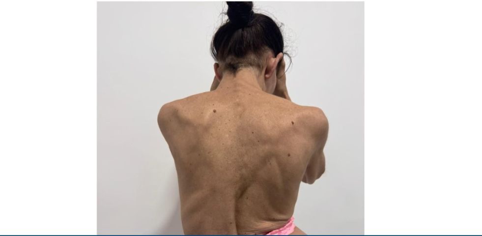 Moradora de Capivari de Baixo cria vaquinha para comprar triciclo adaptado devido à escoliose grave