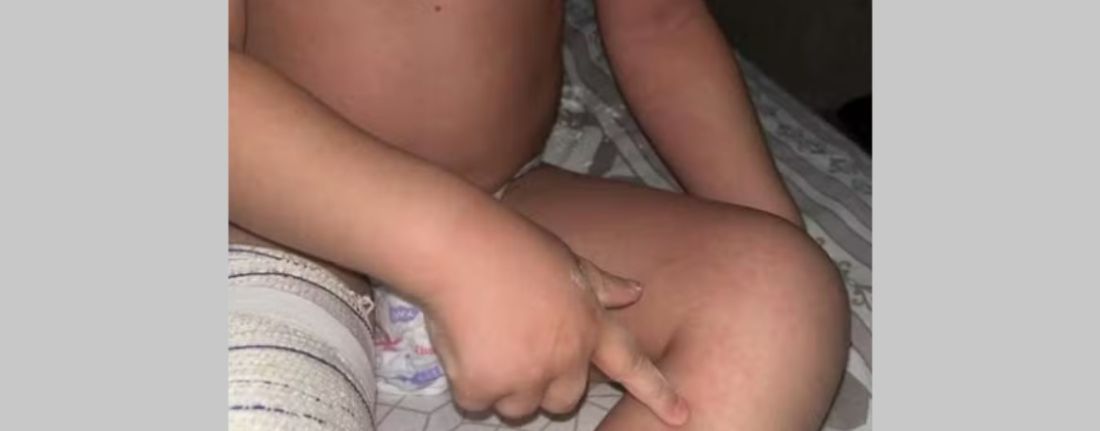 Criança de 2 anos apresenta lesões e acusa o pai de agressão em Braço do Norte; PM e Conselho Tutelar atuam no caso