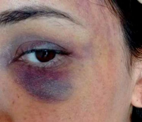 Mulher fica com o rosto marcado por socos e hematomas após agressão do companheiro em Armazém