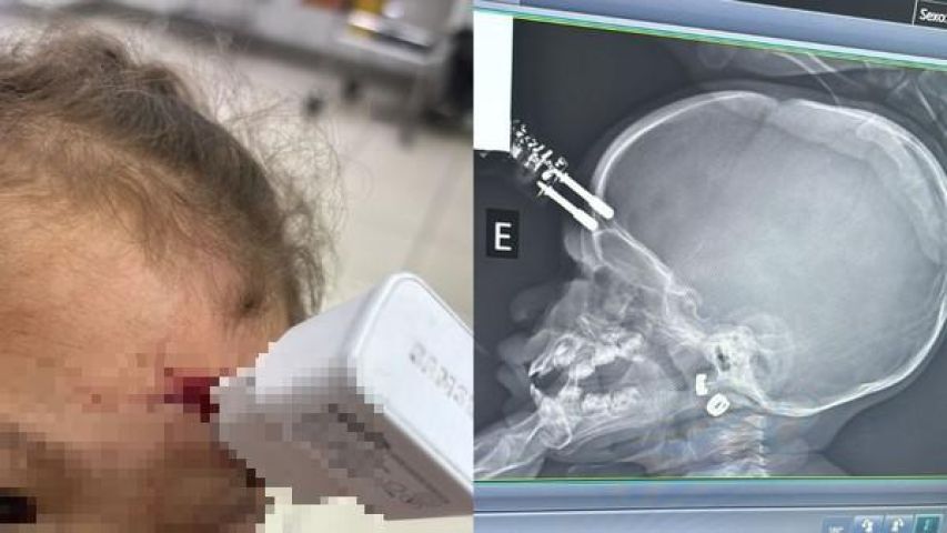 Bebê cai da cama com carregador cravado na testa e passa por cirurgia de urgência em MG