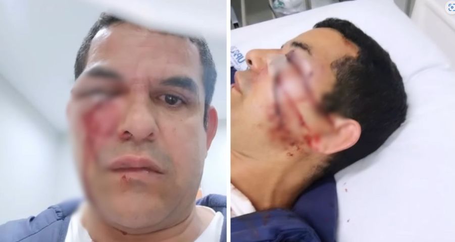 ‘Voz de bichinha’: Homem tem rosto deformado por seis pessoas e denuncia homofobia em SC