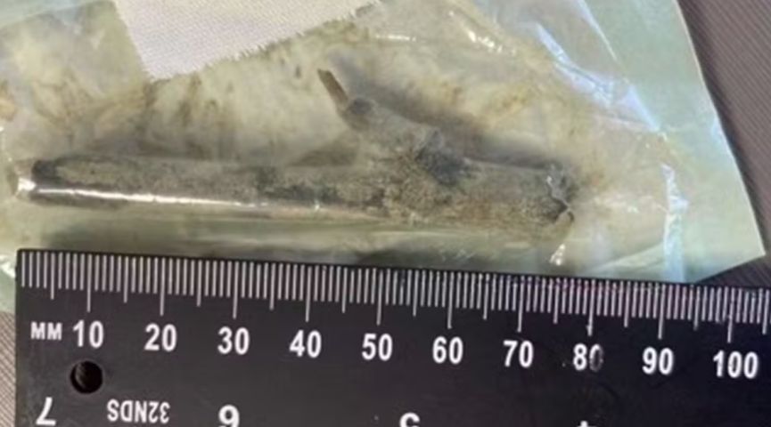 A história do paciente que ficou com pedaço de madeira de 8 cm dentro da perna após erro médico em SC