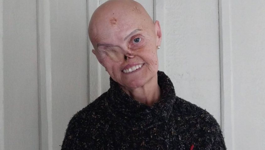 ‘Me chamam de monstro e de ET’: mulher que enfrentou 73 cânceres emociona o país e recebe onda de solidariedade