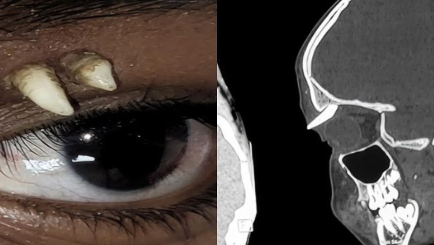 Adolescente procura médico após inchaço no olho e descobre dente crescendo na pálpebra