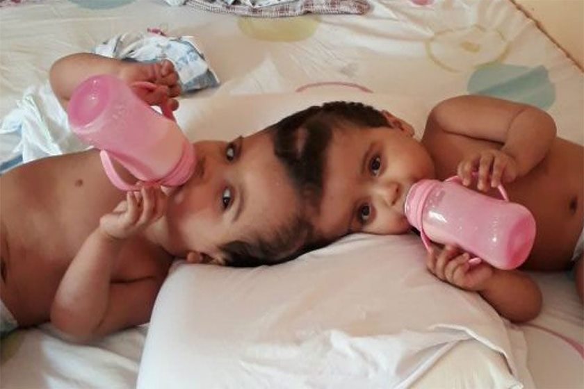 No Brasil: Gêmeas siamesas ligadas pela cabeça são completamente separadas